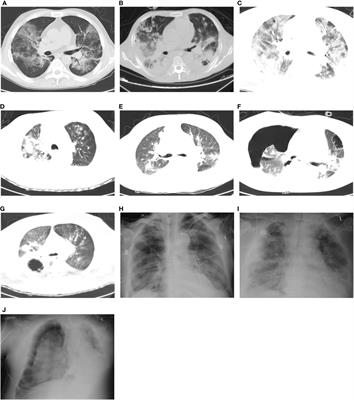 COVID-19 in pulmonary critically ill patients: metagenomic identification of fungi and characterization of pathogenic microorganisms